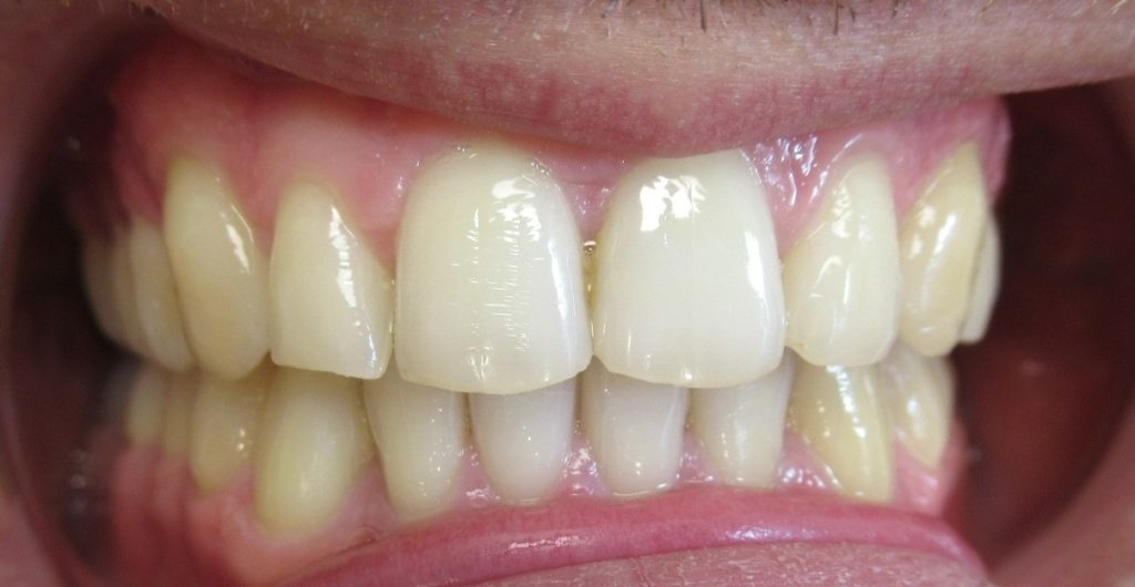Traitement orthodontie adulte d’une supraclusion par aligneurs après