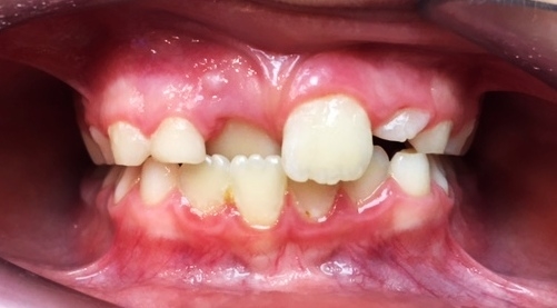 Avant orthodontie de 4 mois d’aligneurs pour correction inversé d’articulé antérieur